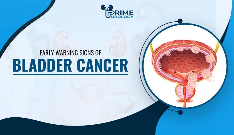 Early Warning Signs of Bladder Cancer